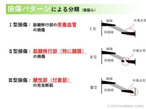 ふくらはぎ肉離れ　種類　画像