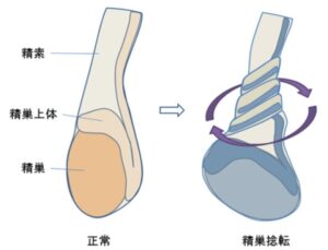 精巣捻転　イラスト　画像